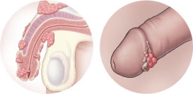 penis kanserinin belirtileri